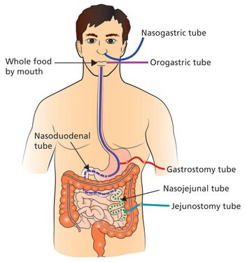 Rute pemasangan enteral feeding tube