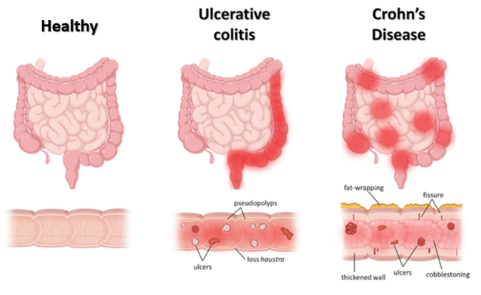 Ilustrasi terkait inflammatory bowel disease