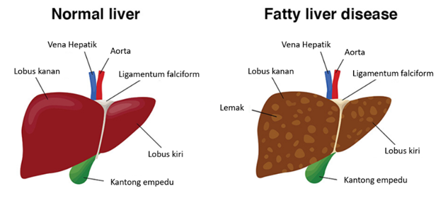 Perbandingan visual liver sehat dan fatty liver yang menunjukkan penumpukan lemak